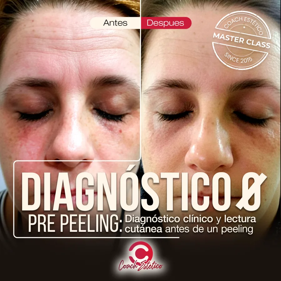 Diagnóstico 0 - Pre Peeling