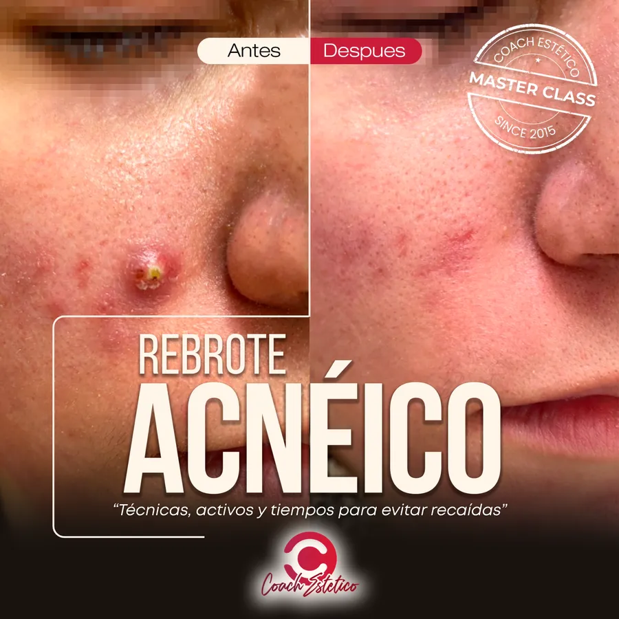 Rebrote Acneico